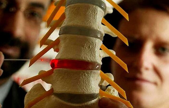 Cambiamenti nell'integrità dei dischi intervertebrali