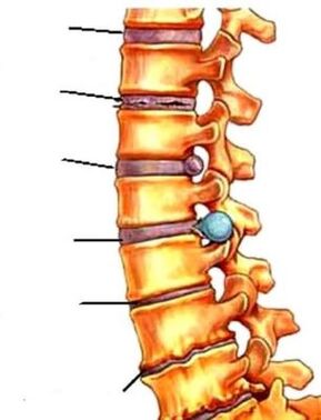 osteocondrite della colonna vertebrale