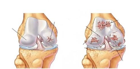 artrosi deformante del ginocchio