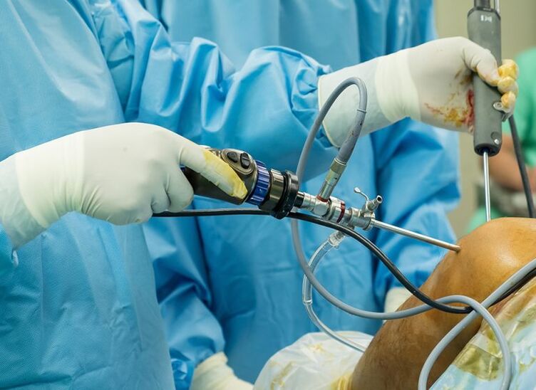 Artroscopia - chirurgia per l'artrosi dell'articolazione del ginocchio