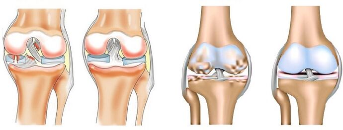 Differenza tra artrite (sinistra) e artrosi (destra) delle articolazioni
