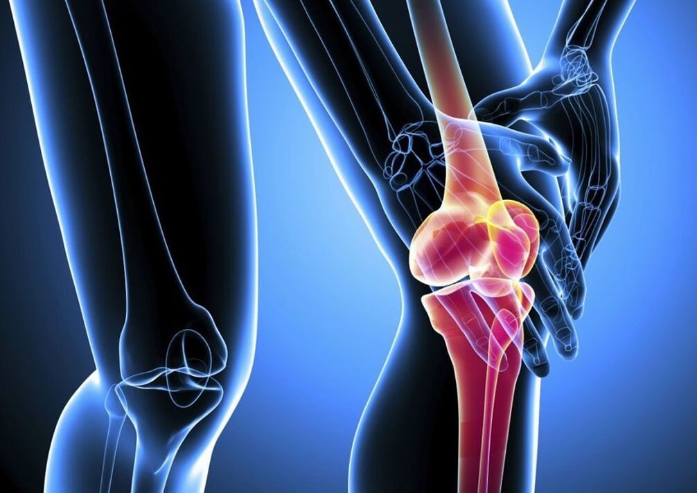 Dolore durante l'attività fisica nell'artrosi dell'articolazione del ginocchio