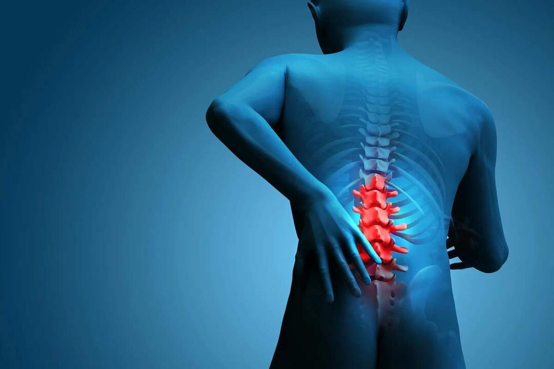 Il sintomo principale dell'osteocondrosi della colonna lombare è il mal di schiena. 