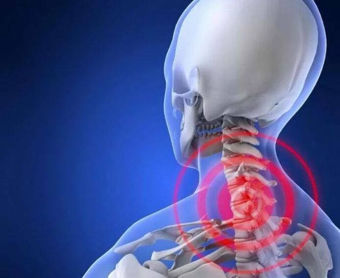 Cos'è l'osteocondrosi