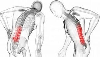 Ernia intervertebrale - complicazione con osteocondosi
