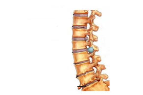Danno alla colonna vertebrale con osteocondosi cervicale