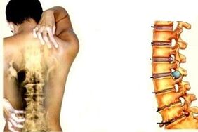 Dolori alla schiena in diverse fasi dello sviluppo dell'osteocondosi cervicale