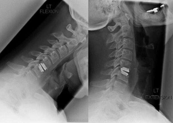 immagine della colonna vertebrale dopo l'intervento chirurgico