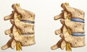 che aspetto ha l'osteocondrosi