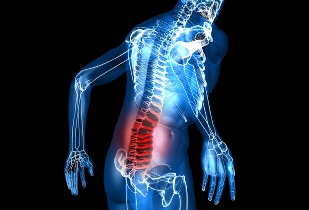 cos'è l'osteocondrosi lombare