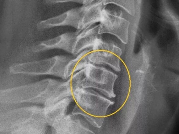 Osteocondrosi del rachide cervicale ai raggi X